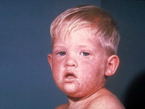 Measles Outbreak